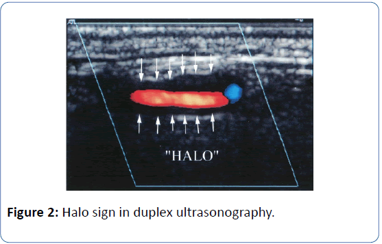 archivesofmedicine-Halo-sign