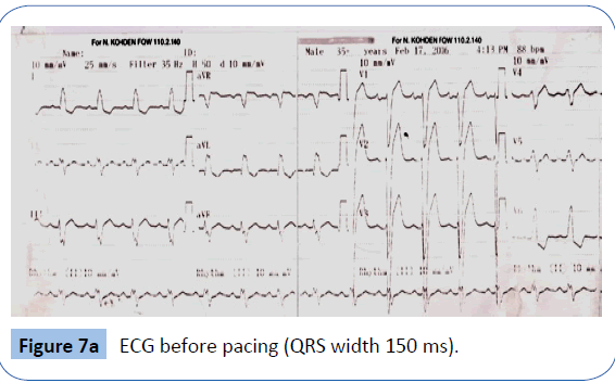 archivesofmedicine-before-pacing