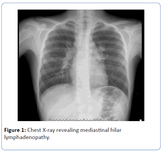 Pediatric Diagnostic Challenge When Hodgkin Lymphoma Mimics