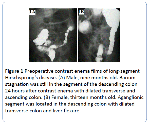 Primary Laparoscopic Deloyers Procedure For Long Segment Hirschsprungaƒa A A A A S Disease Insight Medical Publishing