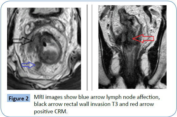 rectal cancer on mri